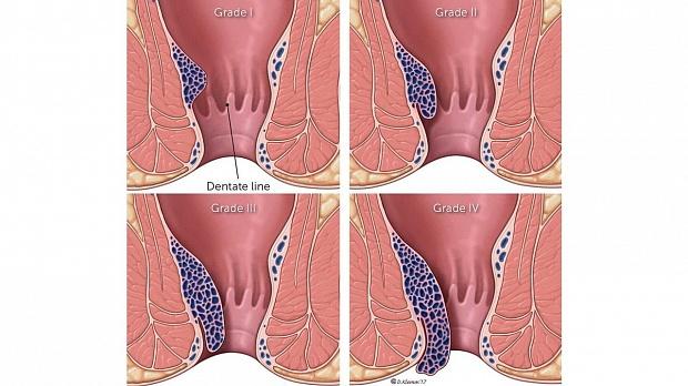 Наружный геморрой - лечение внешних ...