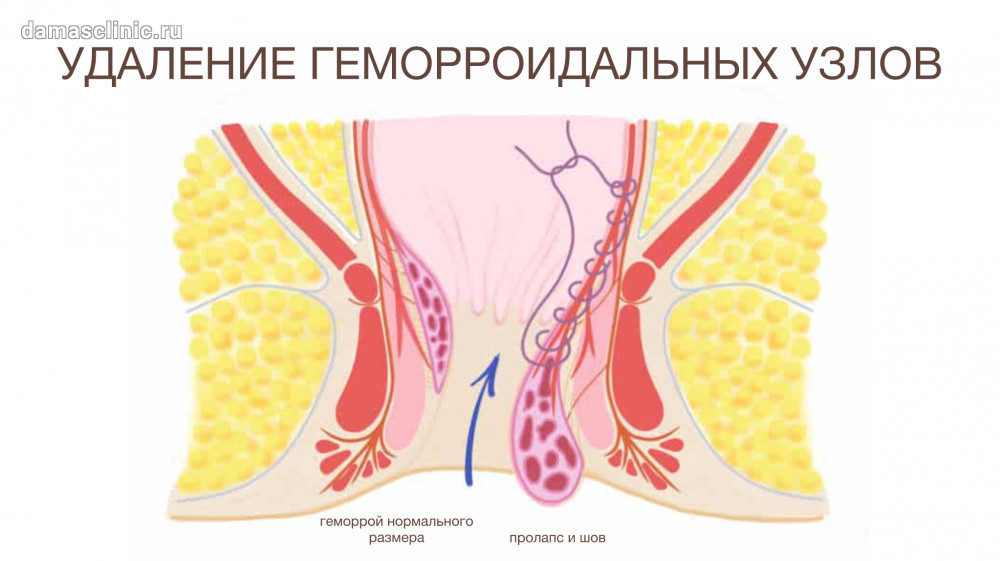 Геморрой: фото, симптомы, в т.ч. при ...