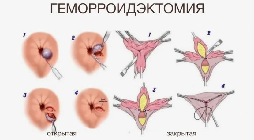 Лечение геморроя