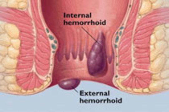 Геморрой, причины, диагностика и ...