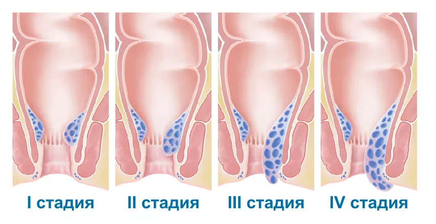 Хронический геморрой