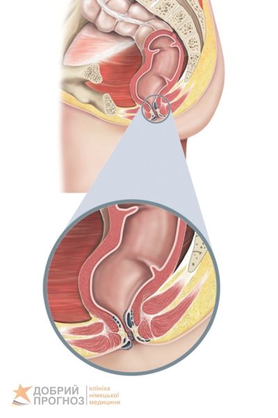 Геморрой — симптомы и лечение геморроя